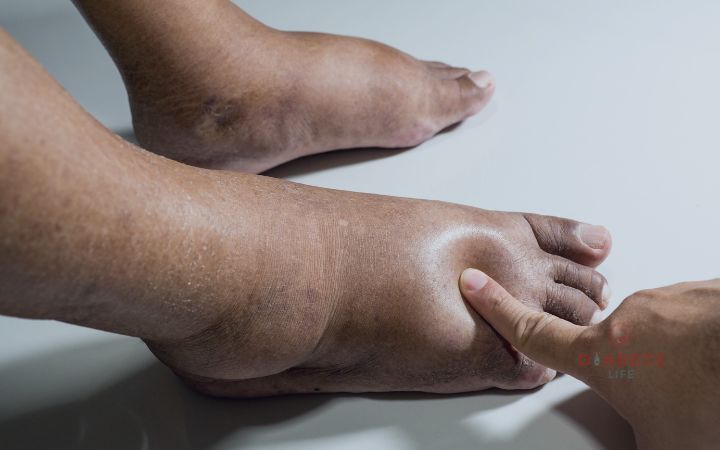 Cuidados com os pés no tratamento do diabetes